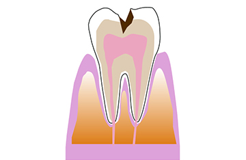 虫歯が象牙質まで進行した状態